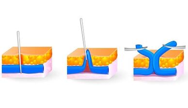 Phlébectomie comme méthode pour traiter les varices