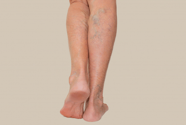 Varices sur les jambes
