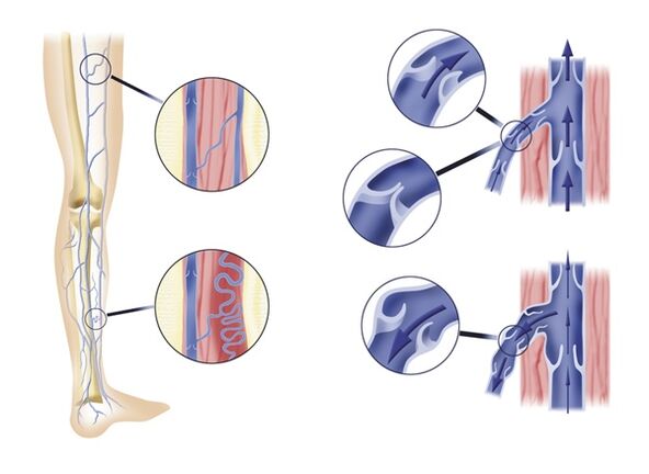 Des valvules veineuses insuffisantes entraînent des varices