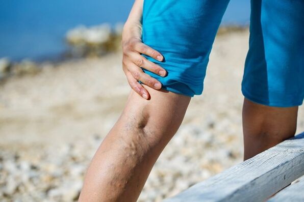 Douleurs piquantes dans les jambes avec varices