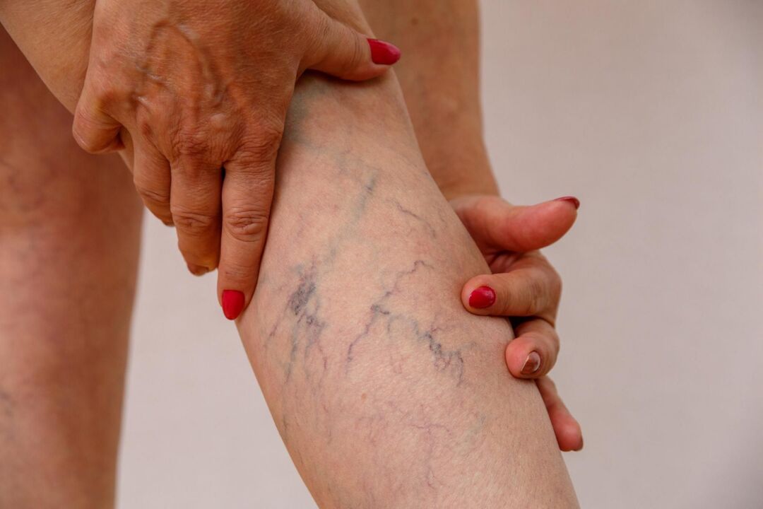 varices dans les jambes