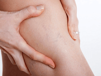 Douleur aux jambes avec varices